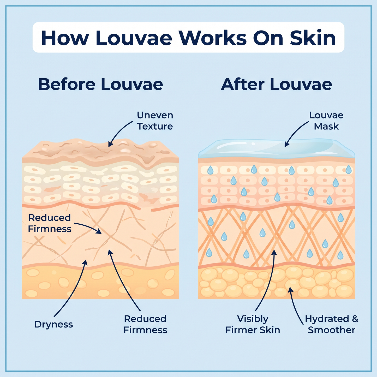 The Louvae Lift™ - Collagen Chin Lift Mask